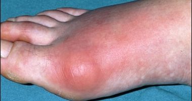 How do I reduce uric acid instantly at home?