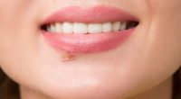 Does Having Herpes Ruin Your Life? Symptoms, Treatment, And Types