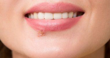 Does Having Herpes Ruin Your Life? Symptoms, Treatment, And Types