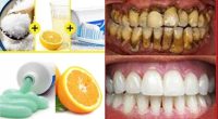 15 Simple Ways To Get White Teeth Overnight