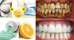 15 Simple Ways To Get White Teeth Overnight