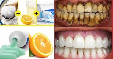 15 Simple Ways To Get White Teeth Overnight
