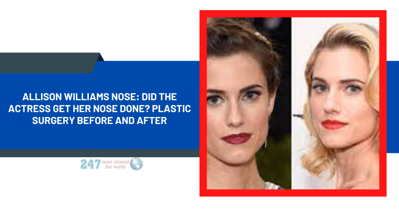 Allison Williams Nose: Did The Actress Get Her Nose Done? Plastic Surgery Before And After