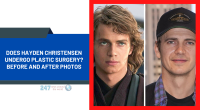 Does Hayden Christensen Undergo Plastic Surgery? Before And After Photos