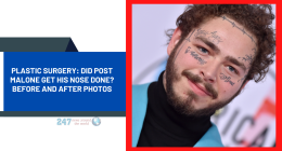 Plastic Surgery: Did Post Malone Get His Nose Done? Before And After Photos