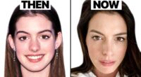 Did Anne Hathaway Undergo Plastic Surgery Or Not? before and after