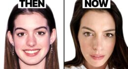 Did Anne Hathaway Undergo Plastic Surgery Or Not? before and after