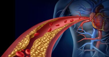 Diabetic Dyslipidemia Symptoms: Risks Factors and Preventions