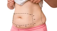 15 Questions to Ask Your Surgeon Before Liposuction