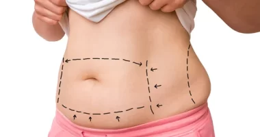 15 Questions to Ask Your Surgeon Before Liposuction