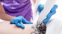 15 Questions To Ask Before The Tattoo Removal Process