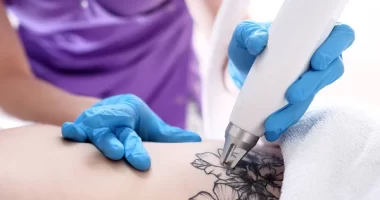 15 Questions To Ask Before The Tattoo Removal Process
