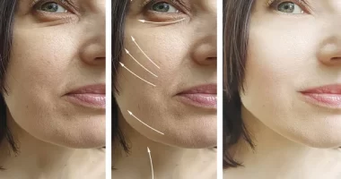 Unlocking The Mysteries: How Long Does A Facelift Last?