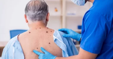 Everything You Need To Know About Mole Removal