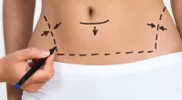 Everything You Need To Know About Abdominal Etching