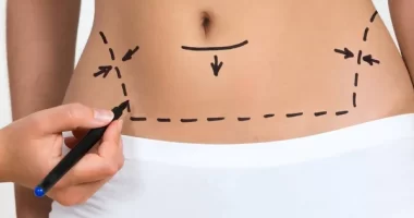 Everything You Need To Know About Abdominal Etching
