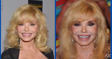 Has Loni Anderson Done Plastic Surgery?