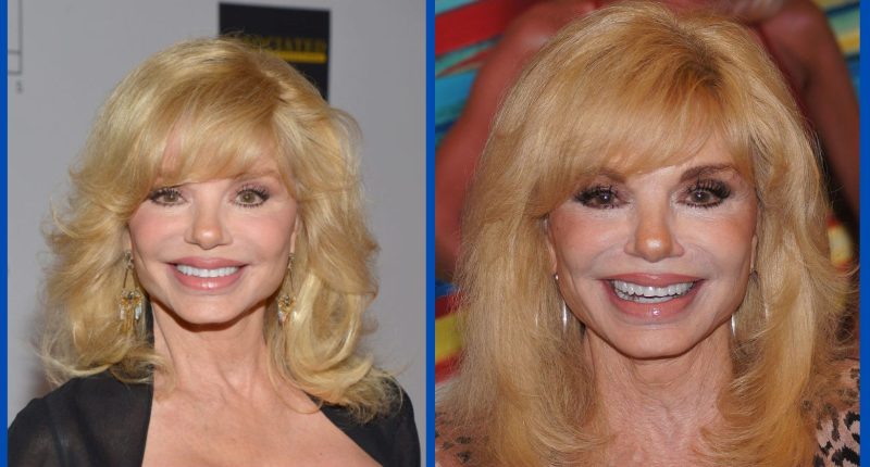 Has Loni Anderson Done Plastic Surgery?