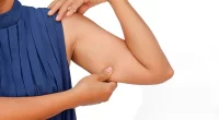 Non Surgical Arm Fat Removal: A Comprehensive Guide