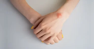Lipoma Treatment Without Surgery: Exploring Non-Invasive Solutions