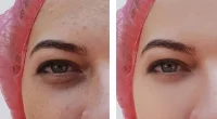 Dark Circles After Rhinoplasty: Causes and Treatment