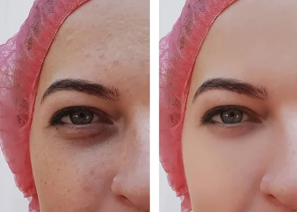 Dark Circles After Rhinoplasty: Causes and Treatment