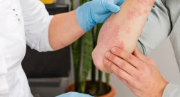 Managing Chronic Inflammation with Psoriasis: Expert Guide