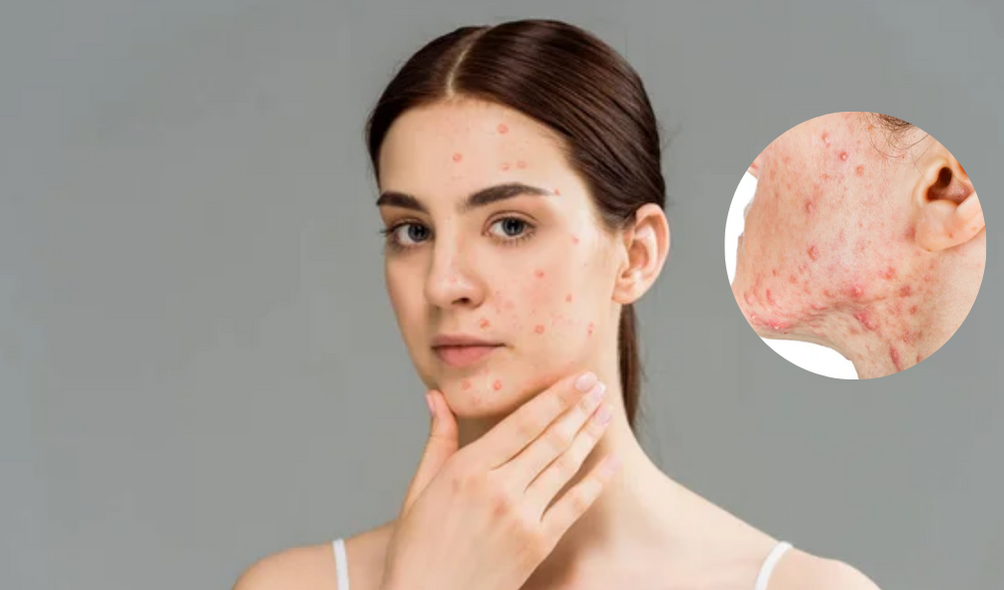 Acne Purging: Causes and Effective Treatment Strategies (A Guide for Clearer Skin)