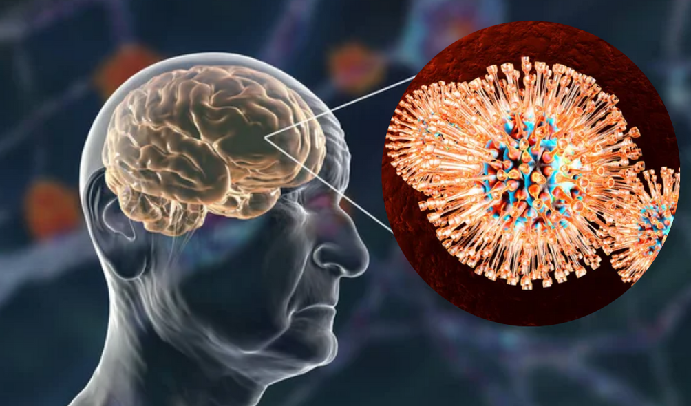 Herpes and Dementia: Doubling the Risk? Understanding the Latest Research and Its Implications