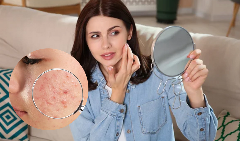 Jawline Acne Treatment: Causes, Cures, and Prevention