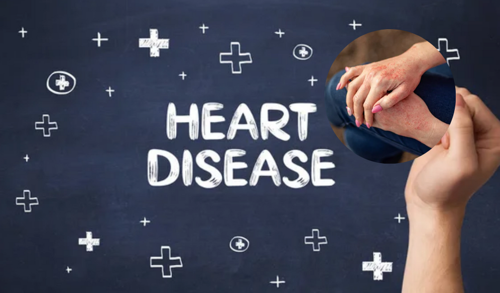 Why People with Severe Psoriasis Have a Higher Risk of Heart Disease: A Deep Dive with a Researcher's Perspective