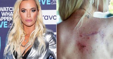 Teddi Mellencamp's Ongoing Fight Against Melanoma: A Call for Skin Health Awareness