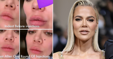 Khloé Kardashian Reveals Facial Fillers After Tumor Surgery