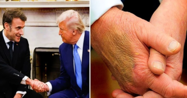 White House Clarifies Trump's Bruised Hand Amid Speculation