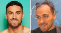 Love Island's Ben Transformation After His £3000 Hair Transplant